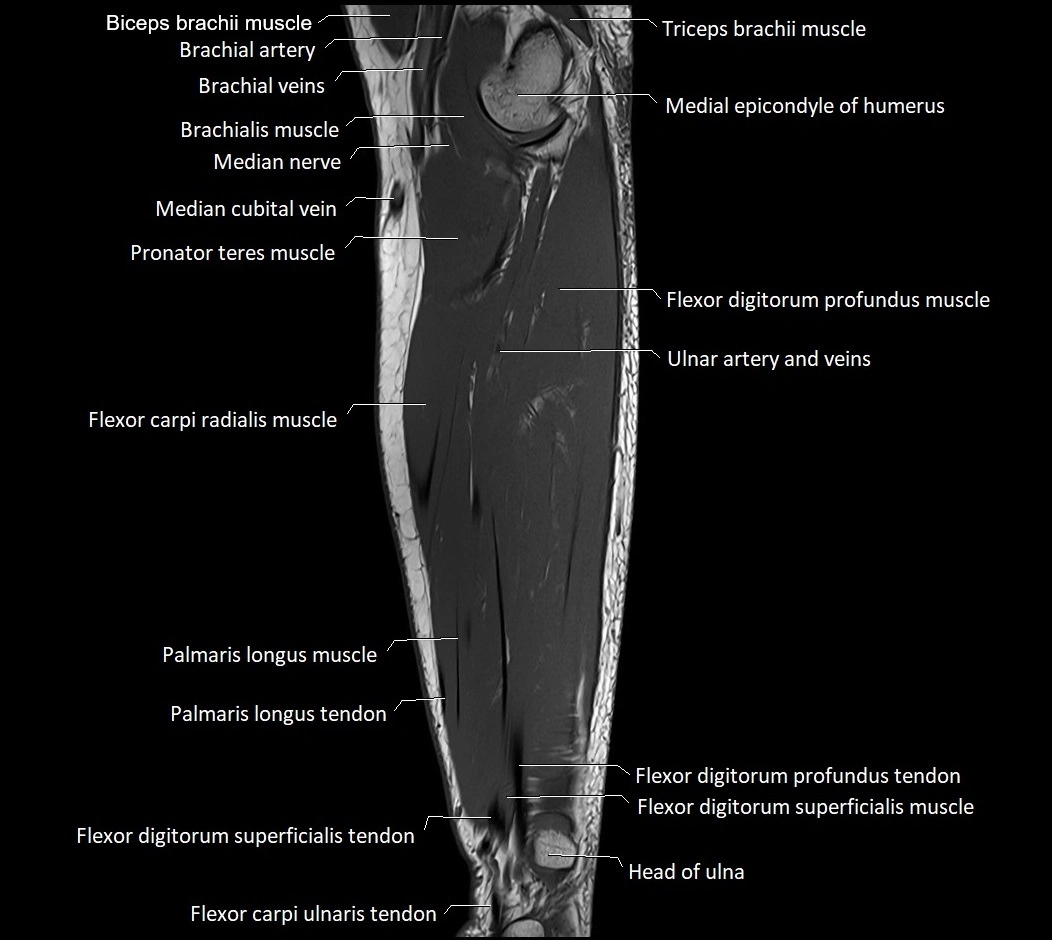 MRI 3T forearm sagittal labelled cross sectional anatomy image 28.webp